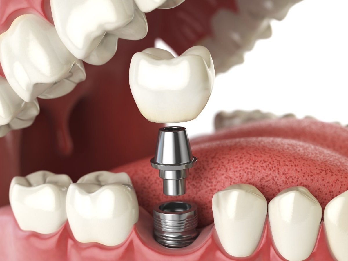 麻坡 Sunrise Dental 种牙咨询服务示意图