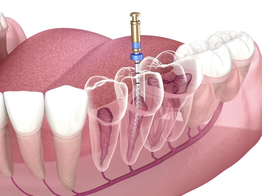 麻坡 Sunrise Dental 根管治疗服务示意图