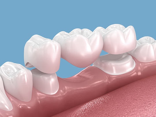 麻坡 Sunrise Dental 牙桥与牙冠服务示意图