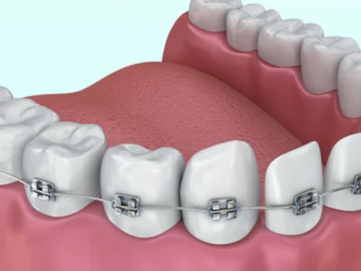 麻坡 Sunrise Dental 箍牙与牙齿矫正服务示意图