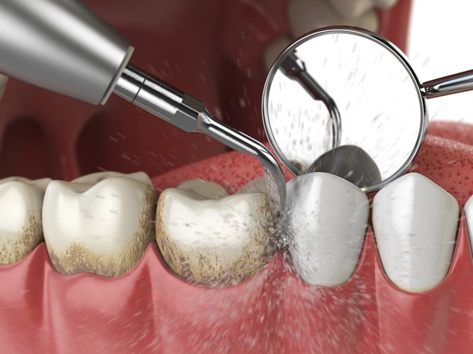 麻坡 Sunrise Dental 牙周护理与洗牙服务示意图