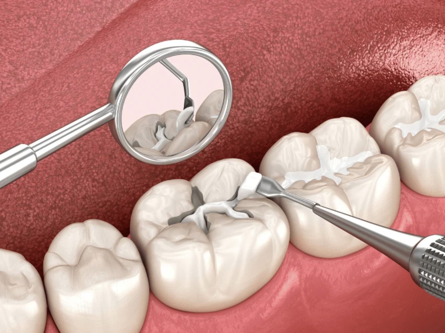 麻坡 Sunrise Dental 牙齿检查与口腔保健服务示意图