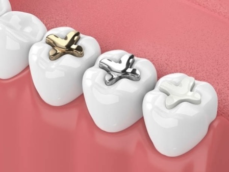 麻坡 Sunrise Dental 补牙服务示意图