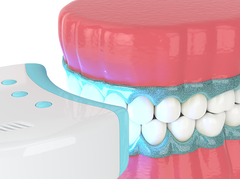 麻坡 Sunrise Dental 牙齿美白咨询服务示意图
